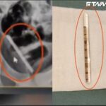 男童「體溫計塞尿道」斷一半滑進膀胱　拿出來長達6.5公分！
